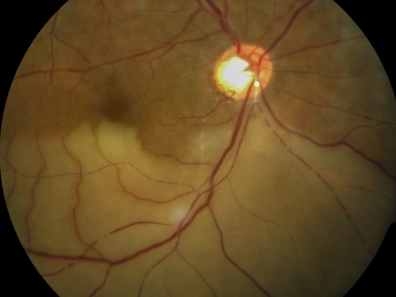 Retinal Vein and Artery Occlusions Plano, TX | Texas Macula and Retina